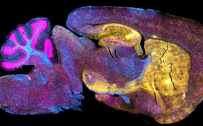 Operational Challenges Drive Innovation in Neurodegenerative Trials