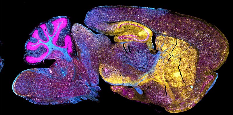 Operational Challenges Drive Innovation in Neurodegenerative Trials